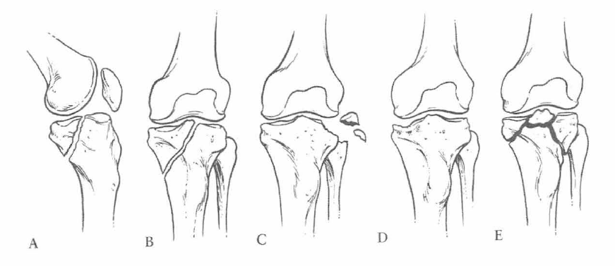 Conceitos: Fratura do Côndilo Tibial Lateral :: Fraturas